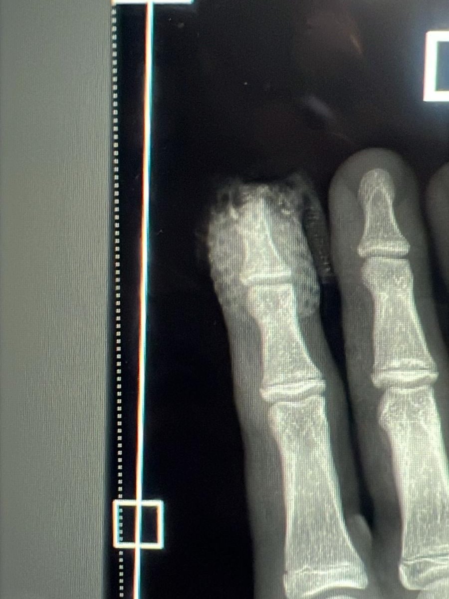 RyonLandXray Ryon Land Xray of Hand